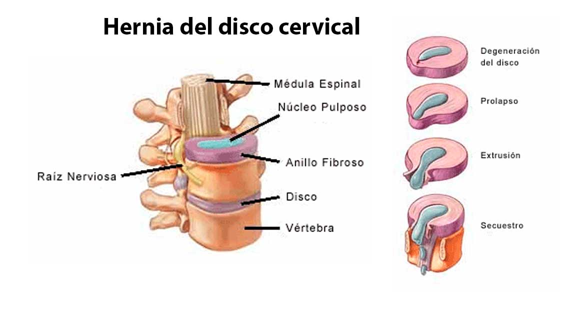 Hernia de disco cervical